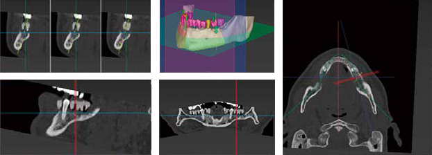 骨密度まで把握し、口腔内情報を患者さまにしっかり説明・共有！・大宮いしはた歯科