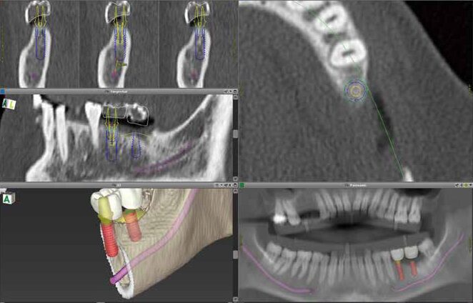 埋入位置、神経の位置などを正確に把握できる・大宮いしはた歯科
