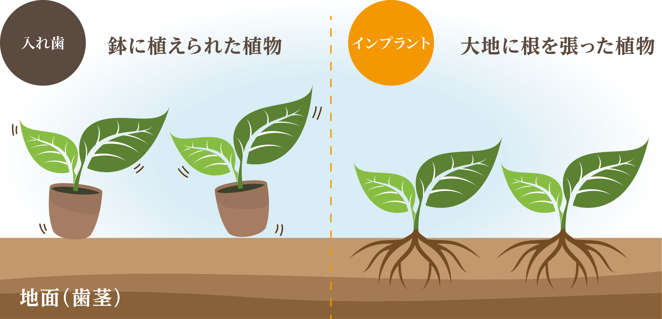 入れ歯とインプラントの違い・大宮いしはた歯科