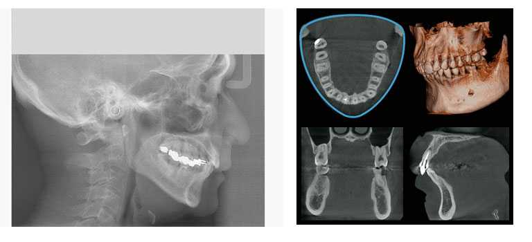 CTのレントゲン撮影・大宮いしはた歯科