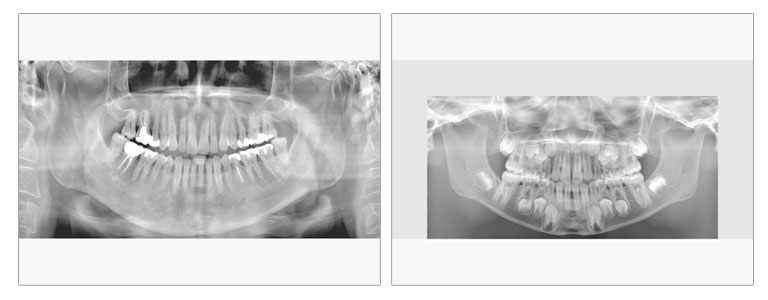 CTレントゲン撮影・大宮いしはた歯科