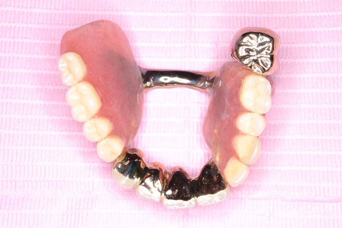 コーヌス義歯とは・大宮いしはた歯科