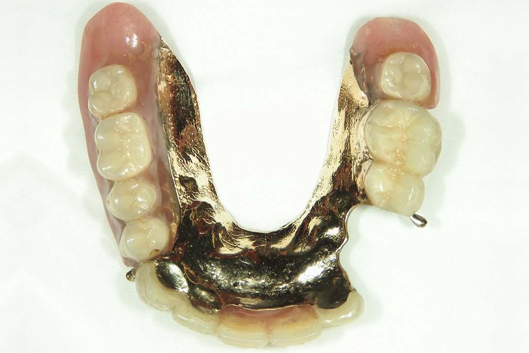 コーヌス義歯・大宮いしはた歯科