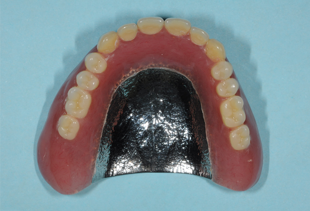 金属床義歯・大宮いしはた歯科