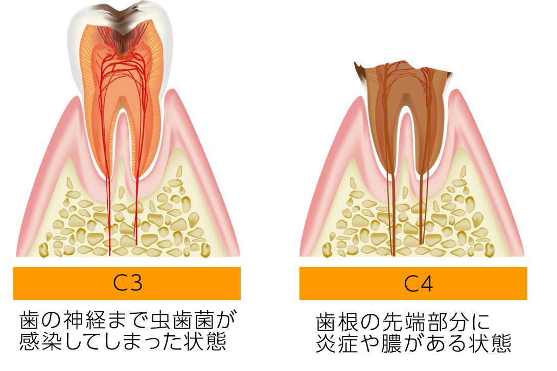 根幹治療が必要な歯の状態・大宮いしはた歯科