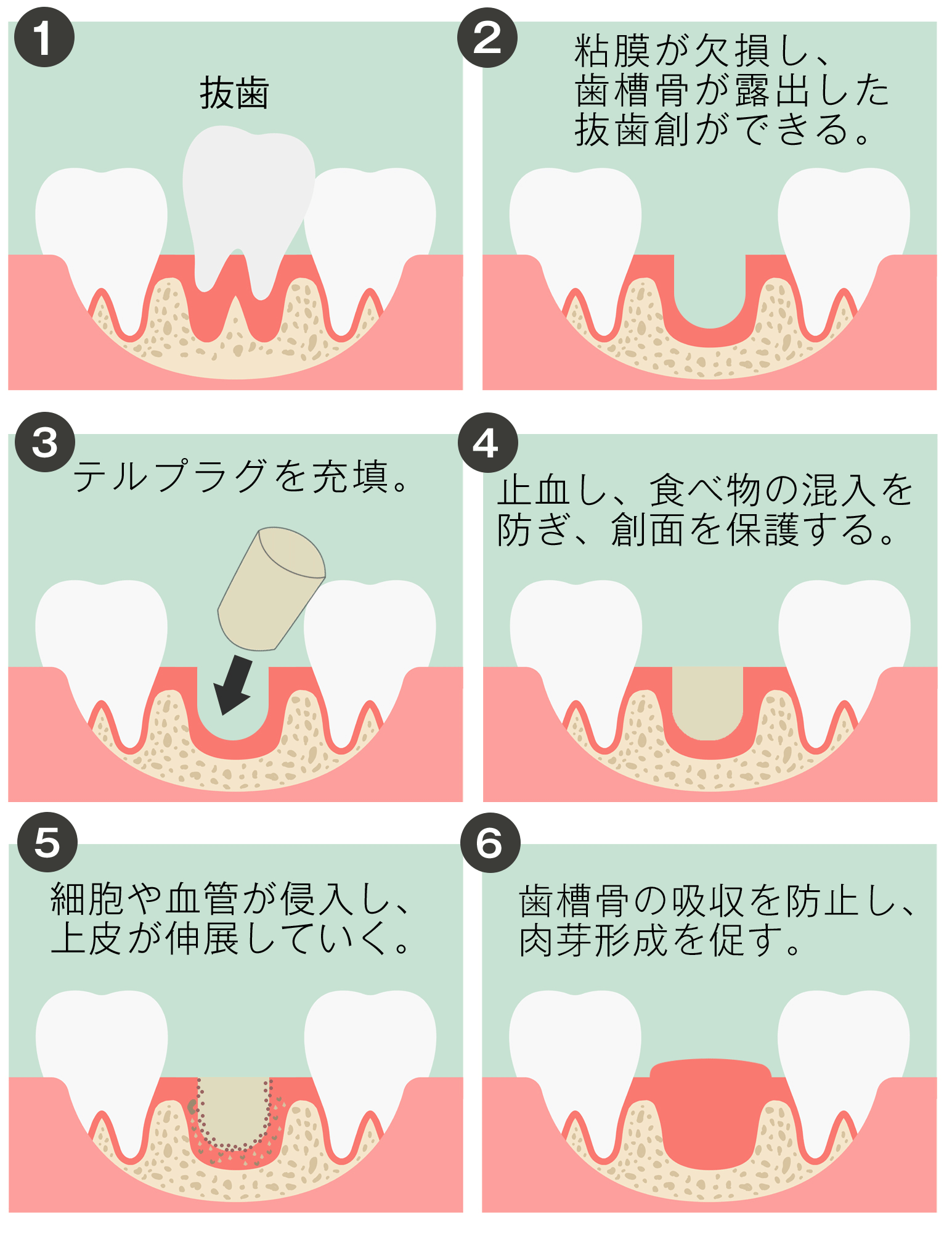 親知らず 人気 抜歯 4 本 同時 費用