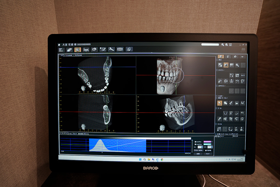 精密治療｜大宮いしはた歯科・大宮駅西口