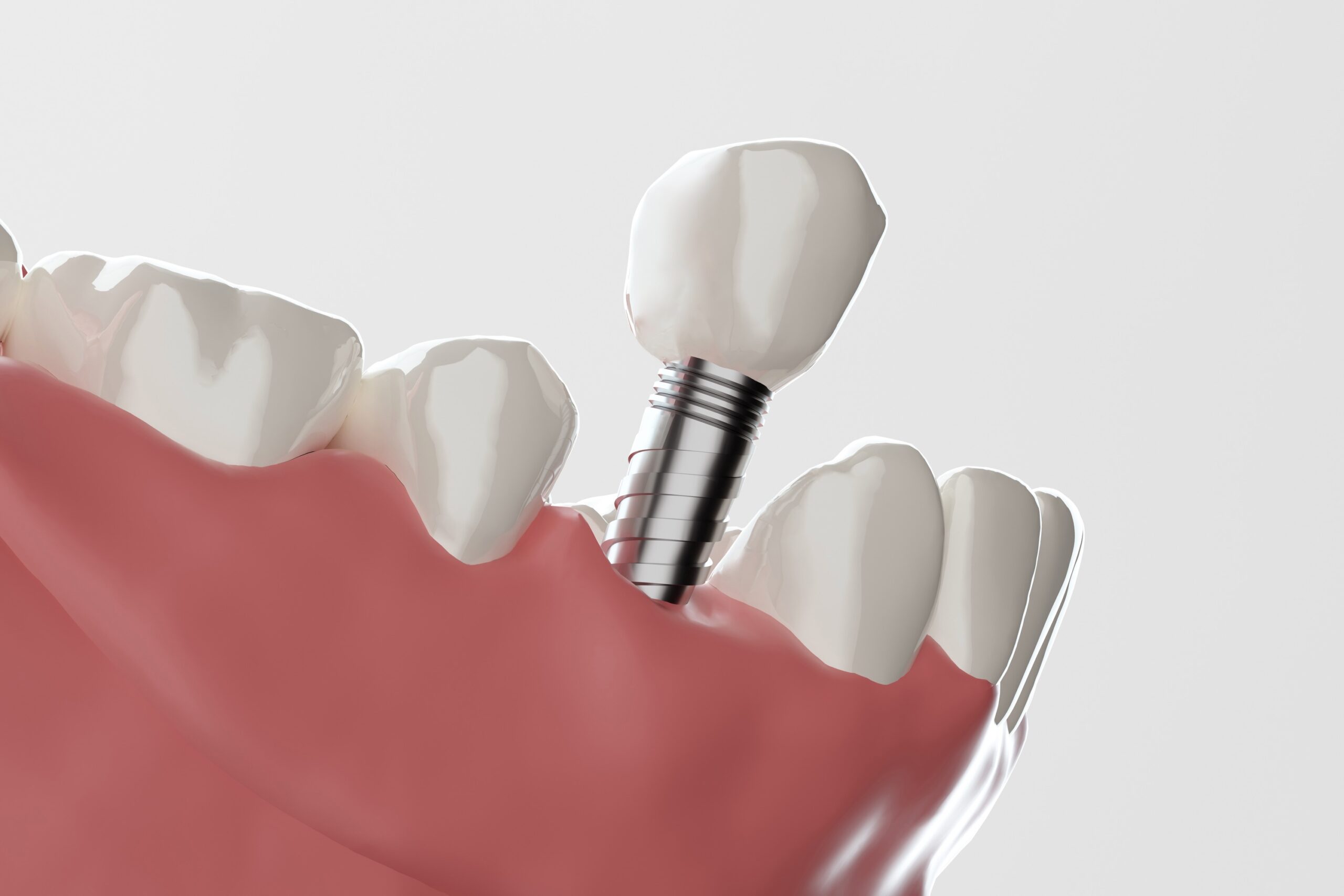 インプラント失敗｜大宮いしはた歯科