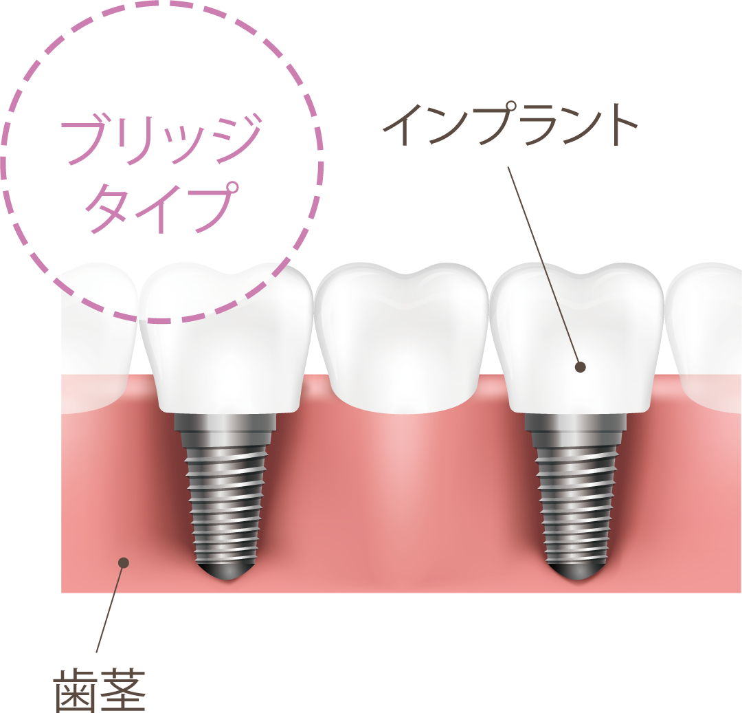 3本欠損、インプラントブリッジ｜大宮いしはた歯科