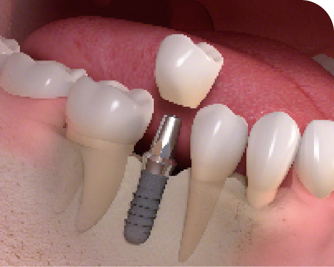 インプラント治療とは