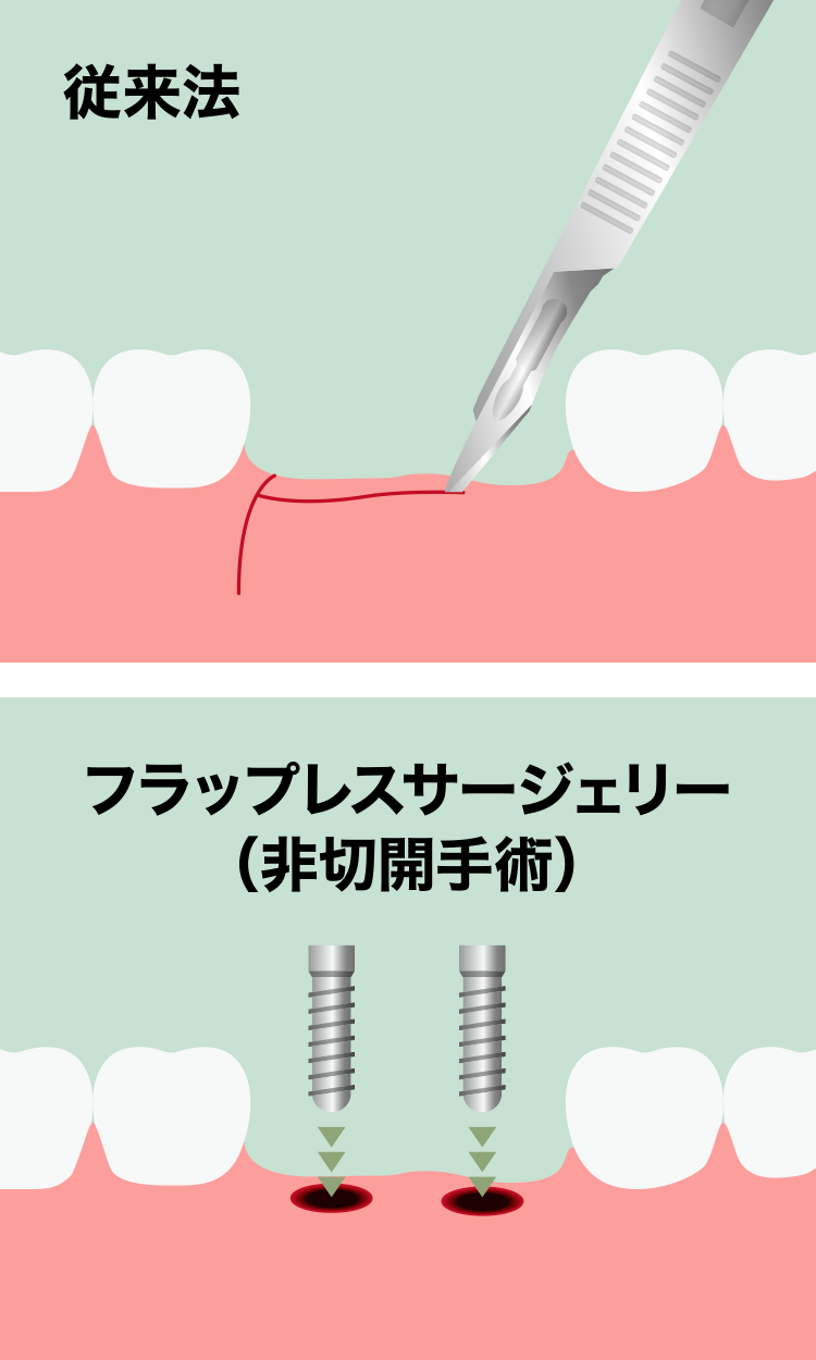 フラップレスサージェリーの方法