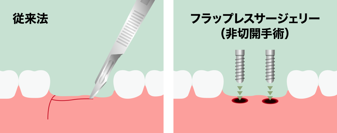 フラップレスサージェリーの方法
