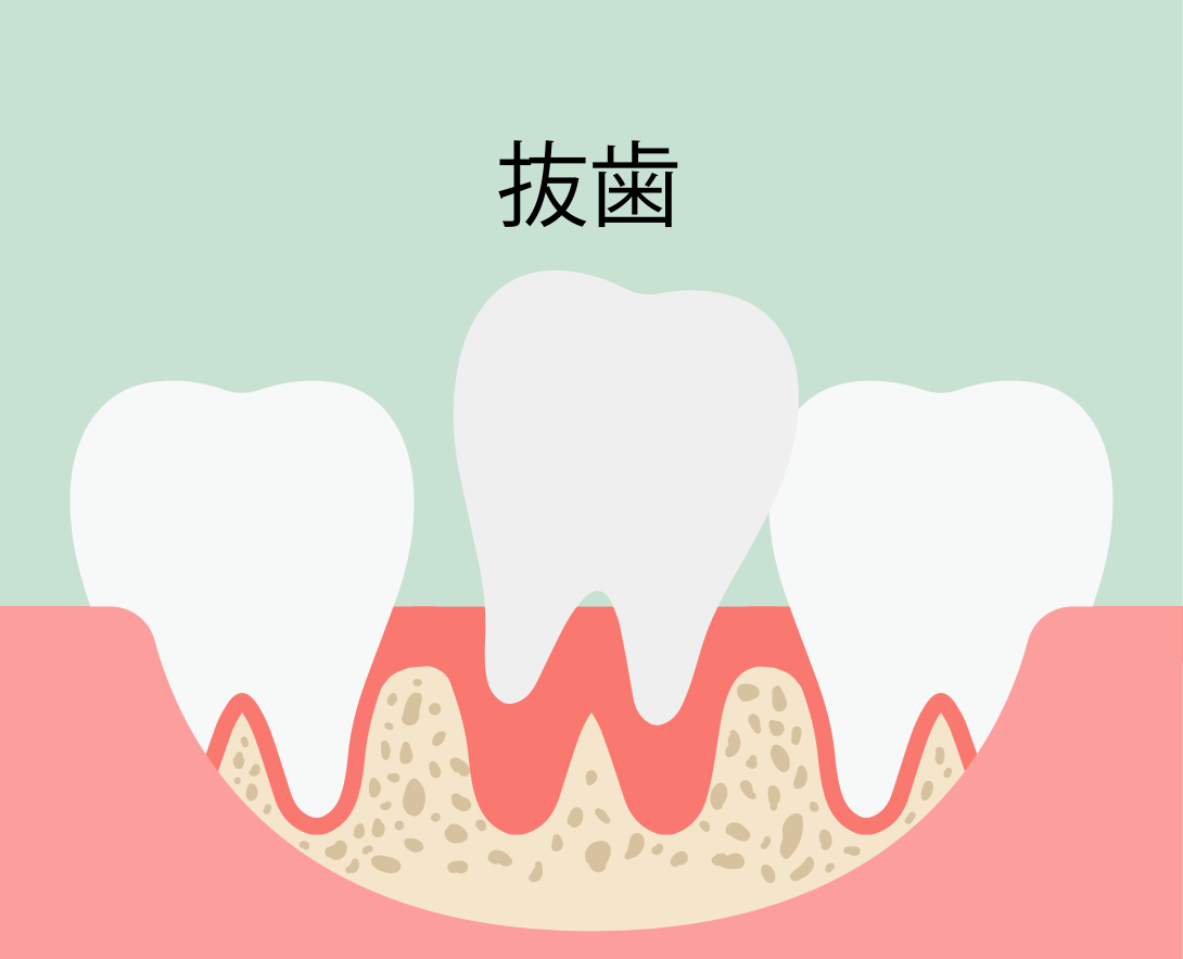 インプラント即時埋入術：手順1 抜歯