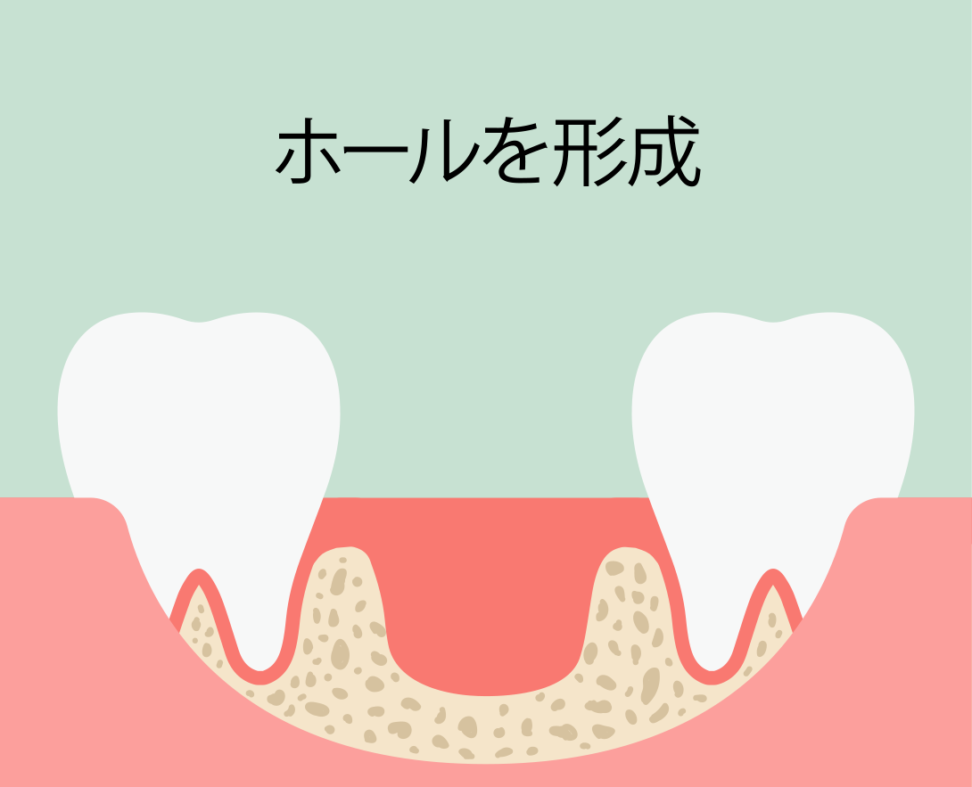 インプラント即時埋入術：手順2 ホールを形成