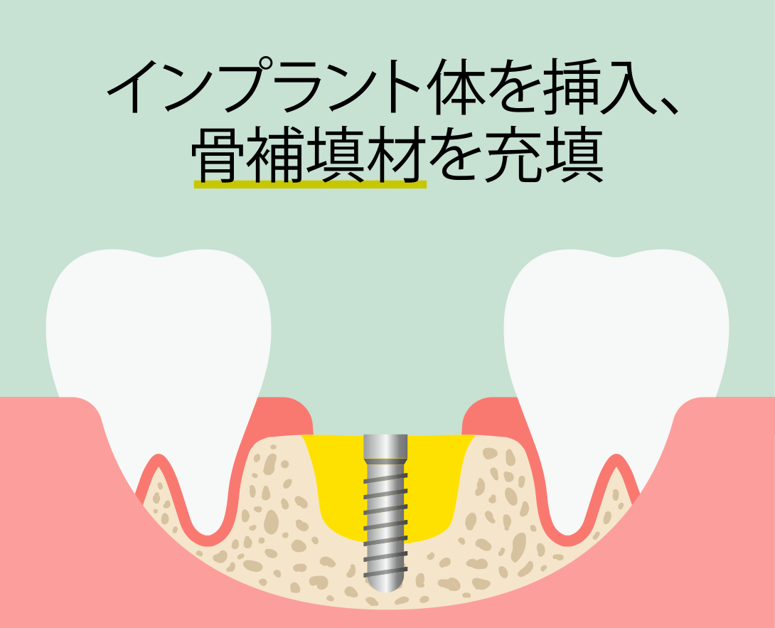 インプラント即時埋入術：手順3 インプラント体を挿入、骨補填材を充填