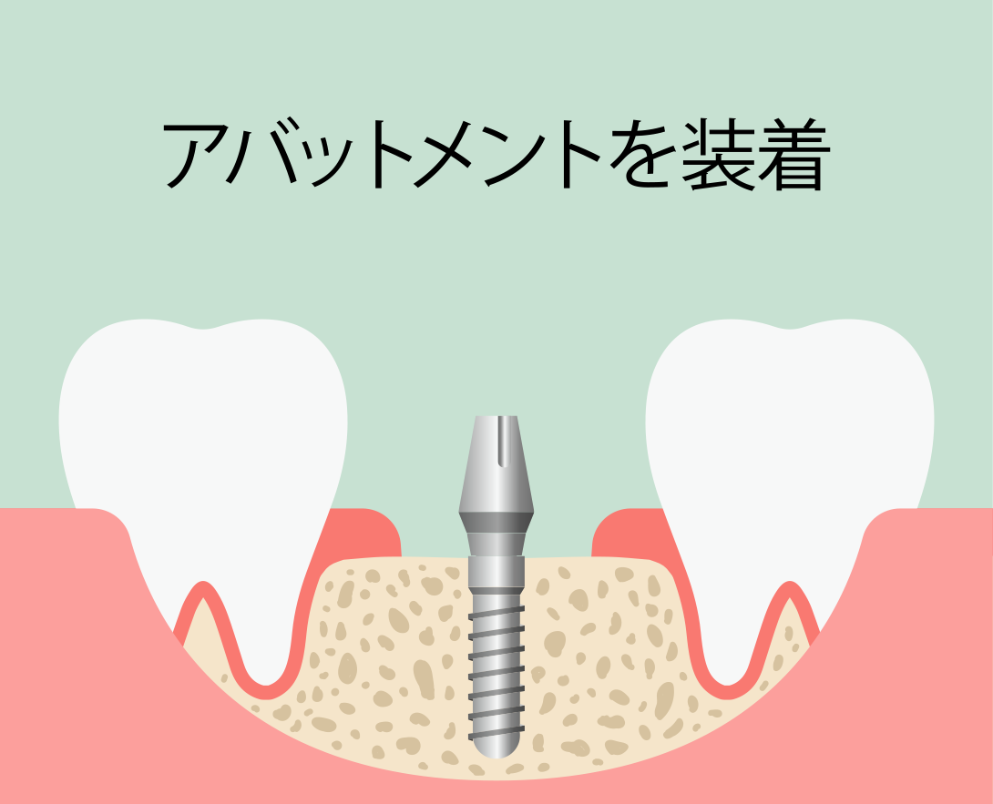 インプラント即時埋入術：手順4 アバットメントを装着