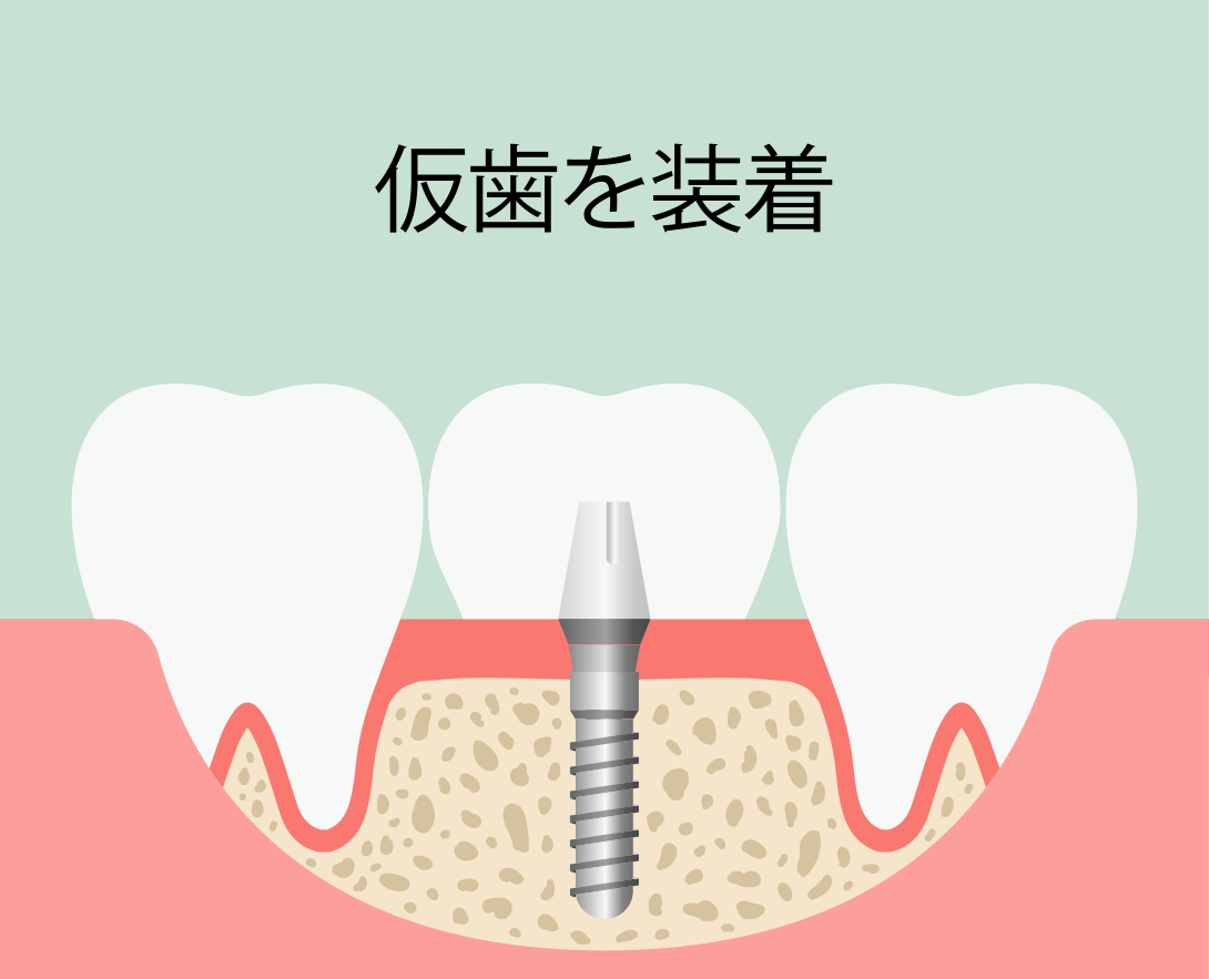 インプラント即時埋入術：手順5 仮歯を装着"