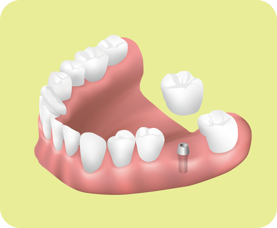 当院でインプラントを受ける