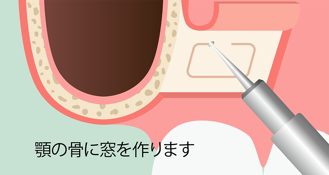 サイナスリフト術 手順2:顎の骨に窓を作ります