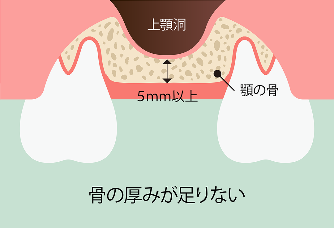 ソケットリフト術：手順1　インプラントを埋入するには骨の厚みが足りない