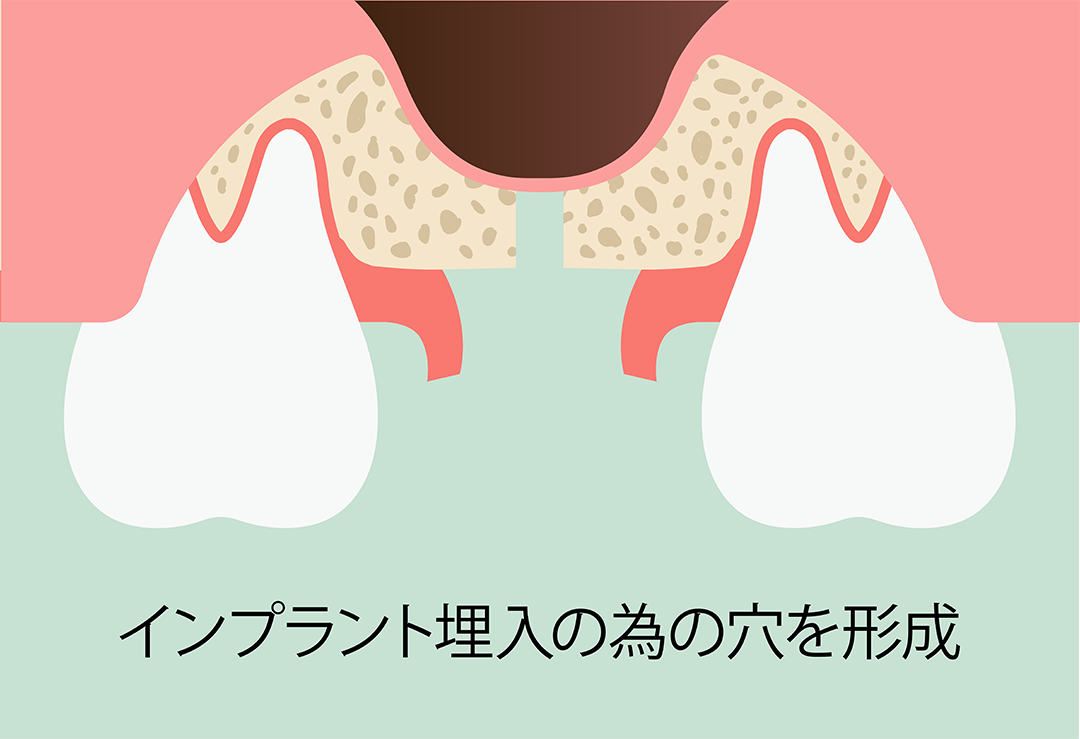 ソケットリフト術：手順2 骨にインプラント埋入の為の穴を形成