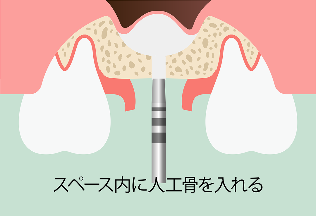 ソケットリフト術：手順4　スペース内に人工骨を入れる