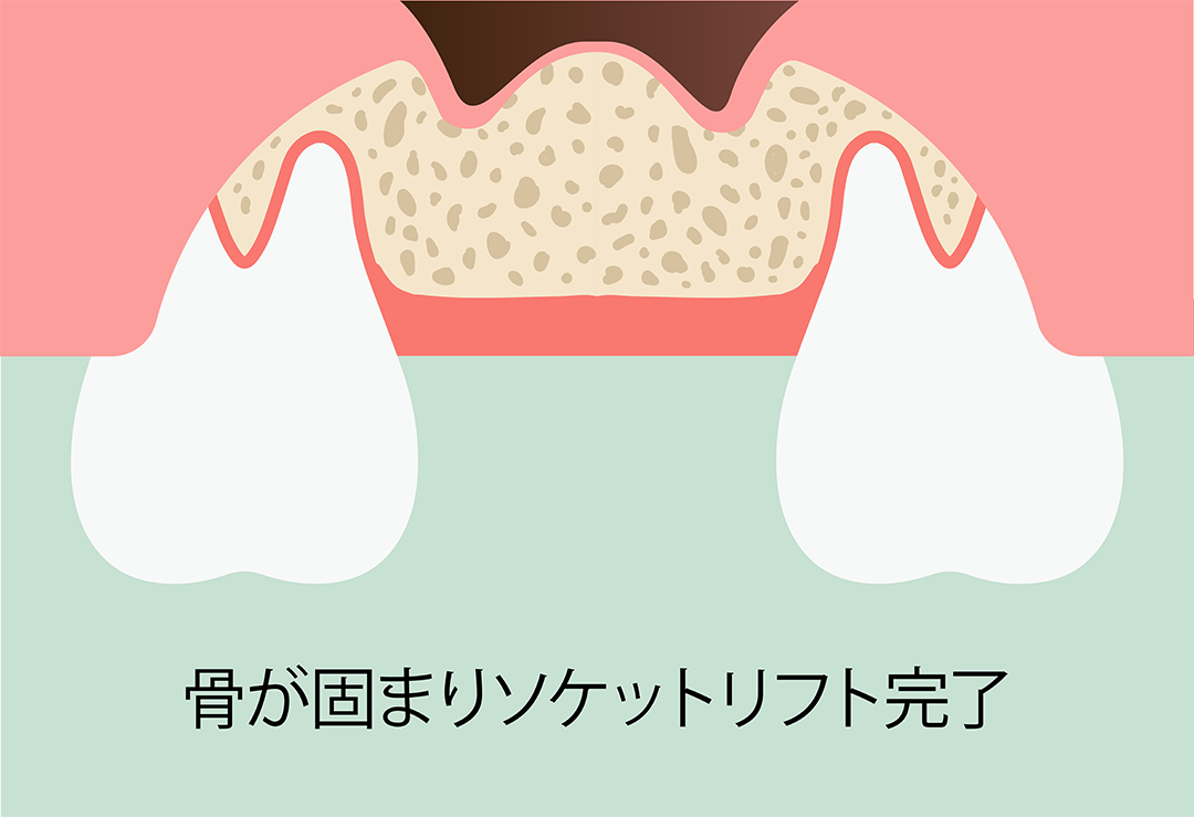 ソケットリフト術：手順5　骨が固まりソケットリフト完了