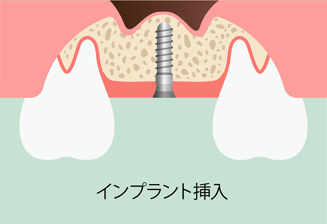 ソケットリフト術：手順6　インプラント挿入