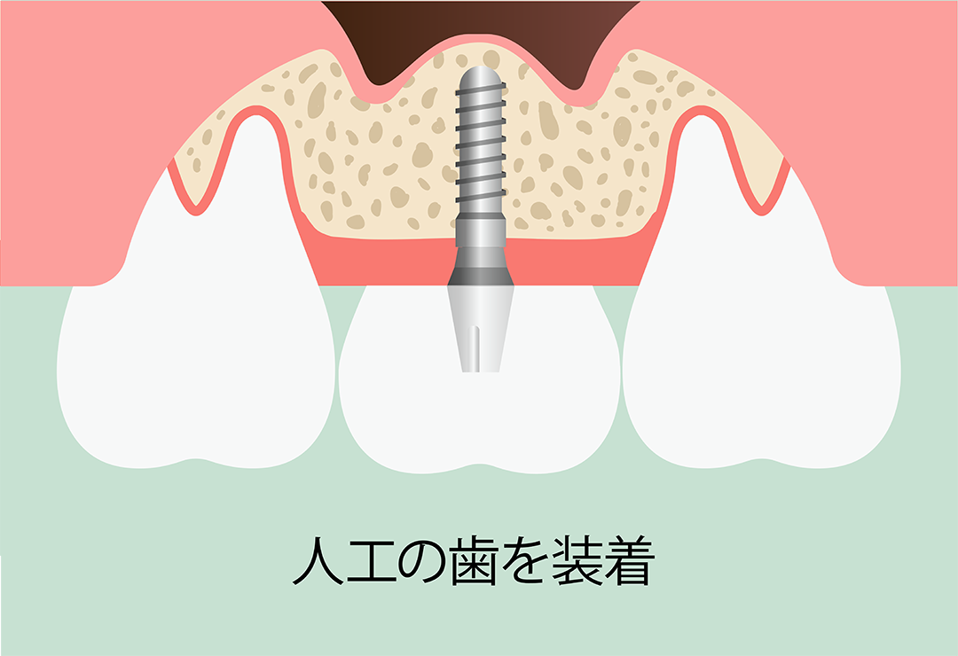 ソケットリフト術：手順7　人工の歯を装着