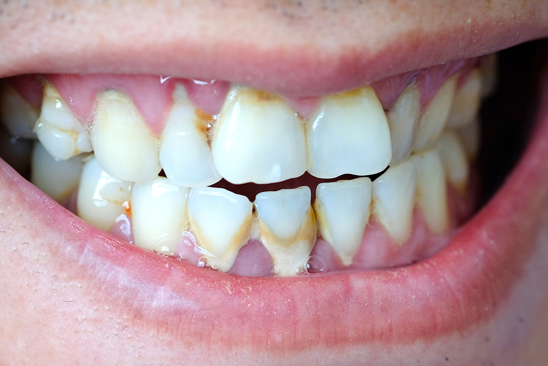 歯石のついた歯｜大宮駅西口の歯医者、大宮いしはた歯科